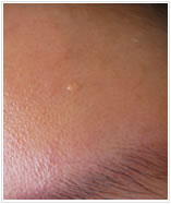 forehead fibroma